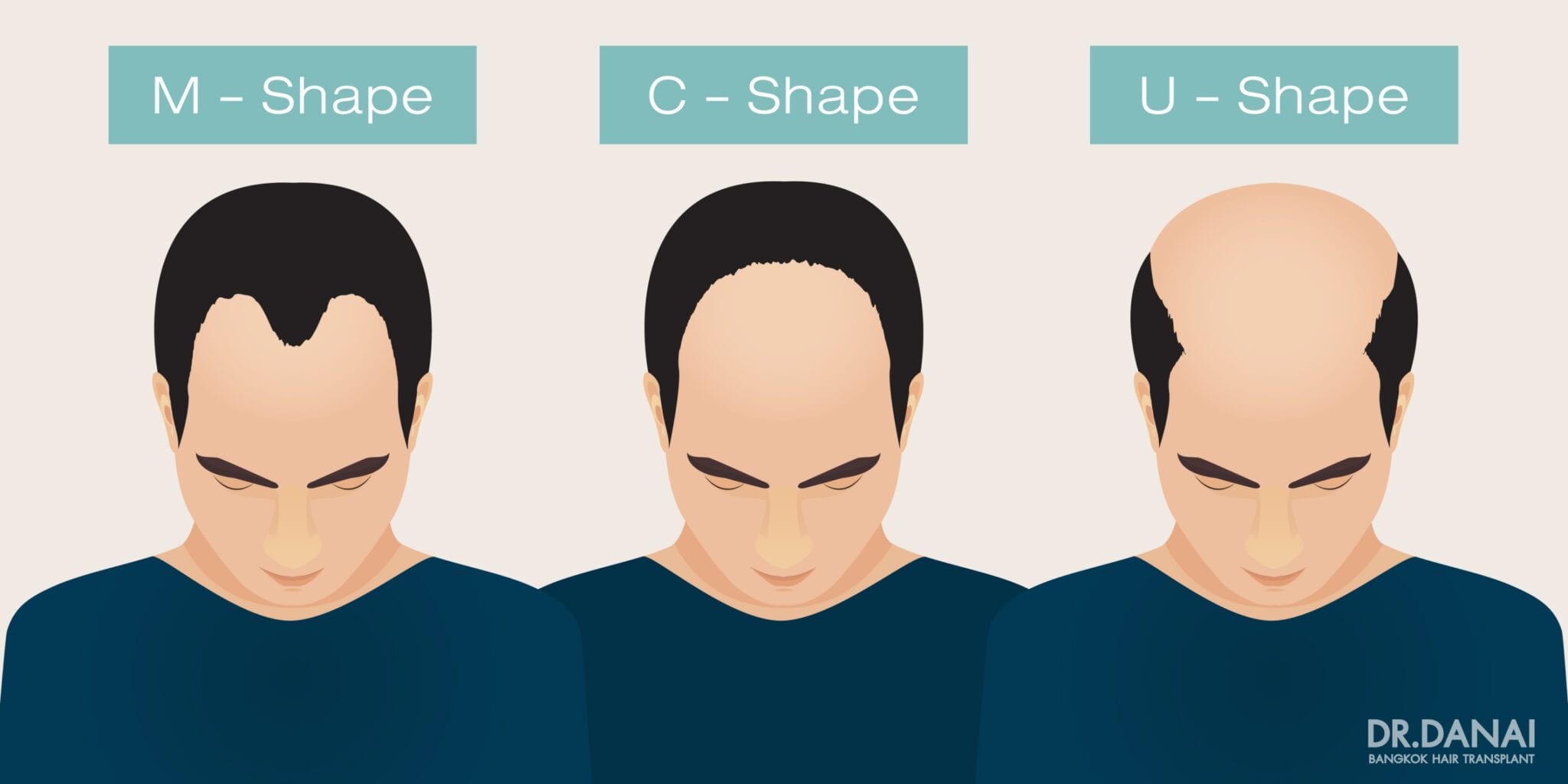 male pattern hair loss